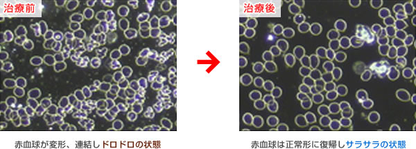 アンチエイジング点滴