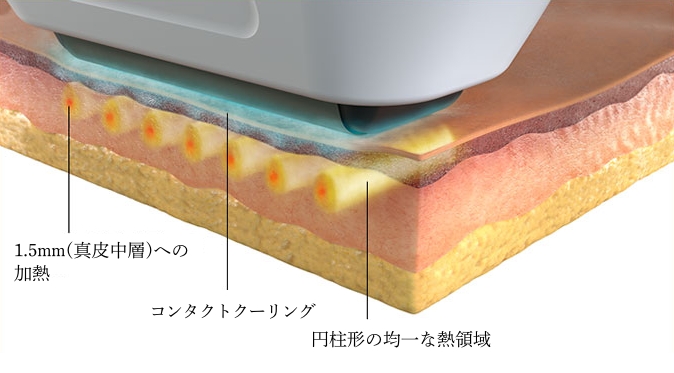 ソフウェーブ（Sofwave）による治療